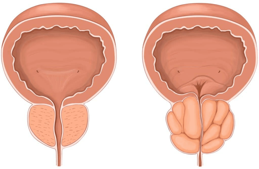 What happens to the prostate during prostatitis