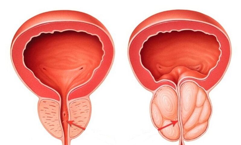 Healthy and inflamed prostate prostatitis